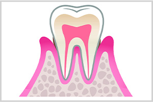 軽度歯周病