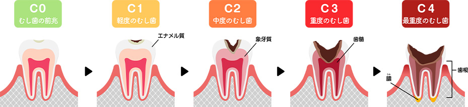 むし歯の進行について