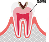 象牙質（エナメル質の内部）のむし歯  (C2)