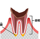 歯根まで達したむし歯 (C4)