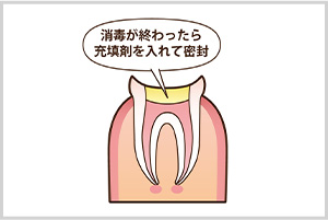 STEP3　薬剤を詰める