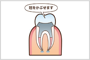 STEP5　かぶせ物を装着