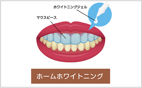 ホームホワイトニング
